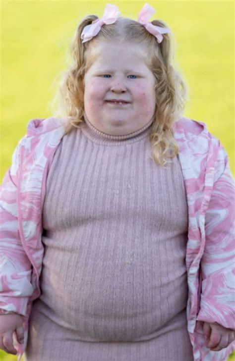 prada willi syndrome|prader willi syndrome in females.